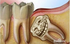 智领未来：多功能智齿的革新之路
