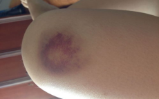 警惕生命警报：这些症状可能是白血病的早期信号